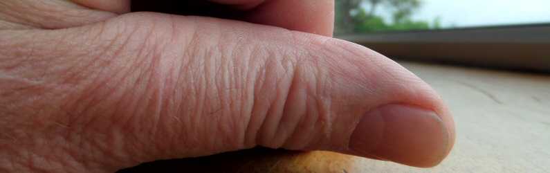 NO SCAR ON THUMB! Thank Heavens for Aloe Vera