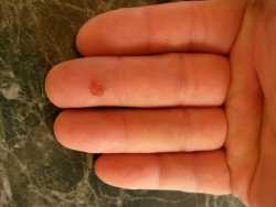 Healing a hand blister with aloe
