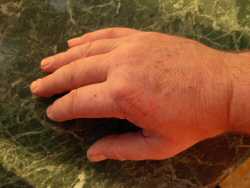 Healing a hand scratch with aloe