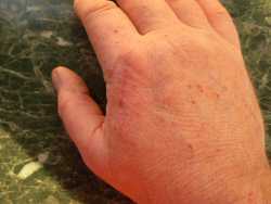 Healing a hand scratch with aloe
