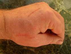 Healing a hand scratch with aloe