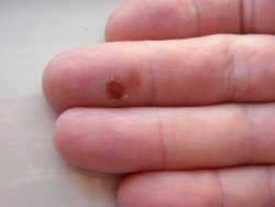 Healing a hand blister with aloe