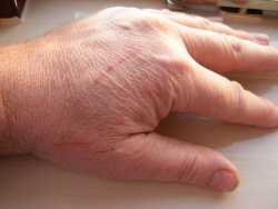 Healing a hand scratch with aloe