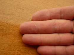 Healing a hand blister with aloe