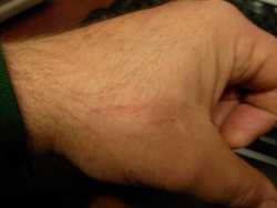 Healing a hand scratch with aloe