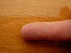 Healing a hand blister with aloe