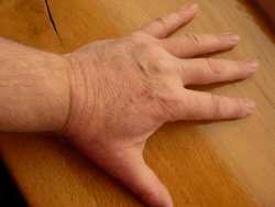 Healing a hand scratch with aloe