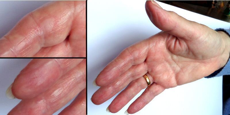 Blistered Hand Following a Scald Accident