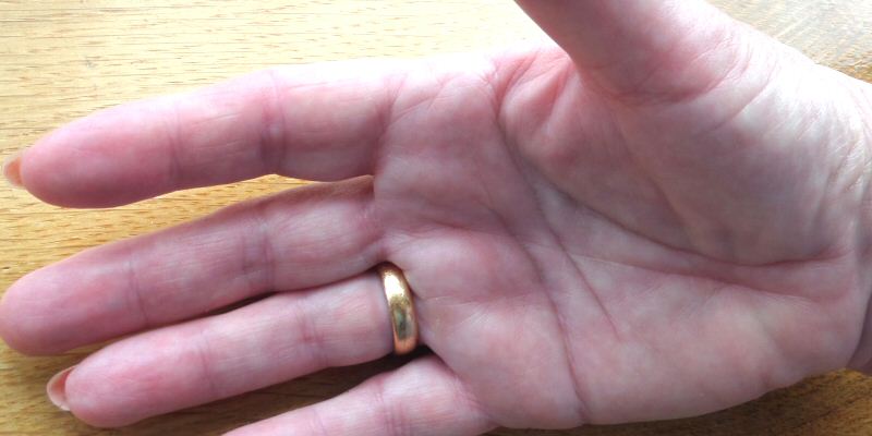 Burned Hand Repaired in Seven Days